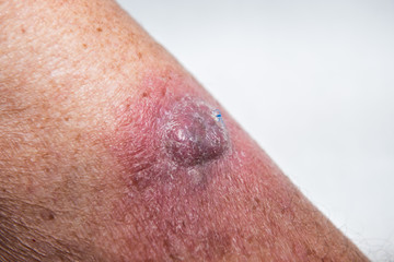 Fototapeta premium Squamous skin cell cancer