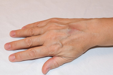 The consequence of infusion in fragile or sclerosed veins.