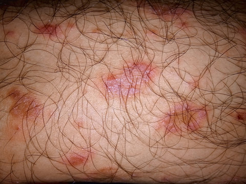 Pityriasis rosea on skin closeup. Fungal infections that cause rashes, dermatophytes, eczema, ringworm. Healthcare concept. Selective focus