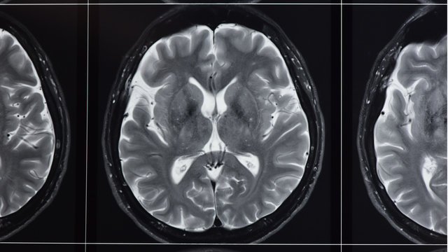 Photograph of T2 weighted magnetic resonance imaging of normal brain