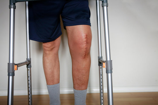 Painful Scar After Knee Surgery Stock Photo - Download Image Now