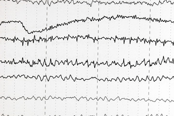Brain wave patterns on electroencephalogram, EEG of the pediatric patients, problems in the...