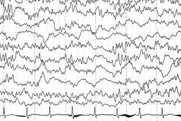 Brain wave patterns on electroencephalogram, EEG of the pediatric patients, problems in the...
