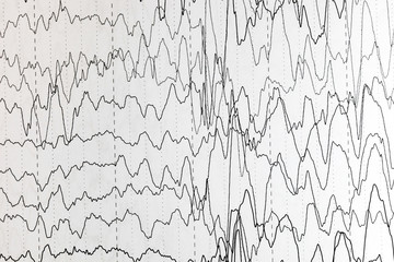 Brain wave patterns on electroencephalogram, EEG of the pediatric patients, problems in the...