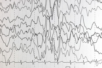 Brain wave patterns on electroencephalogram, EEG of the pediatric patients, problems in the...