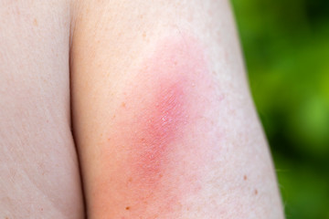 Fototapeta premium Lyme disease