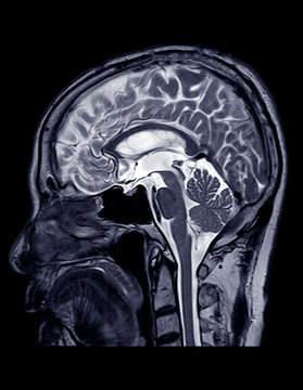 MRI of the brain sagittal plane for detect a variety of conditions of the brain such as cysts, tumors, bleeding, swelling, developmental and structural abnormalities, infections.