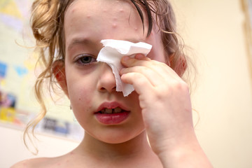 Portrait of child has skin infected with chickenpox