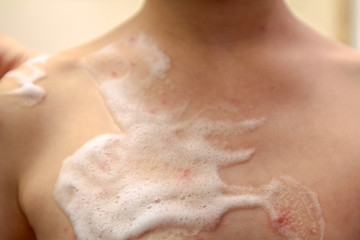 Fototapeta premium Therapy against the virus of Varicella has measles, chicken pox, rubella