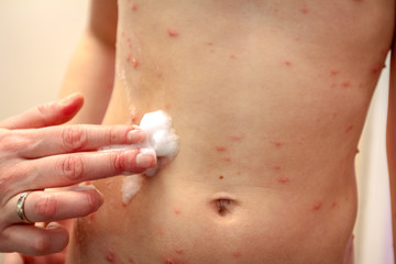 Therapy against the virus of Varicella has measles, chicken pox, rubella