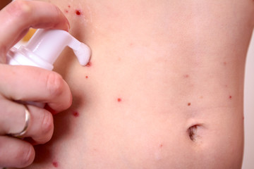 Therapy against the virus of Varicella has measles, chicken pox, rubella