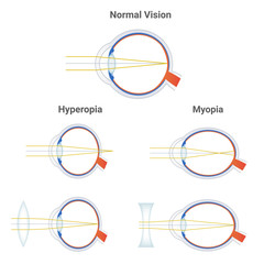 Myopia, hyperopia and normal vision. Common vision disorders. Short sightedness, far sightedness and corrected eye by plus positive lens and minus negative lens. Icons with focusing of light isolated.