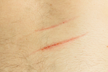 A scratch on the human body. Scar close-up. A deep cut on the body.