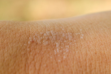 Blisters on human skin on the hand from sunburn close-up. Macro.