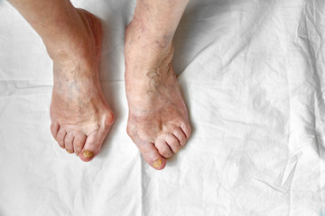 Closeup of a foot with damaged nails because of fungus. Elderly woman legs. Diabetis