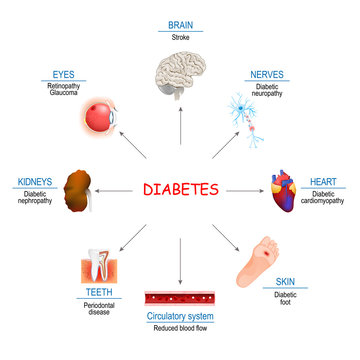 Diabetes Affects and Complications