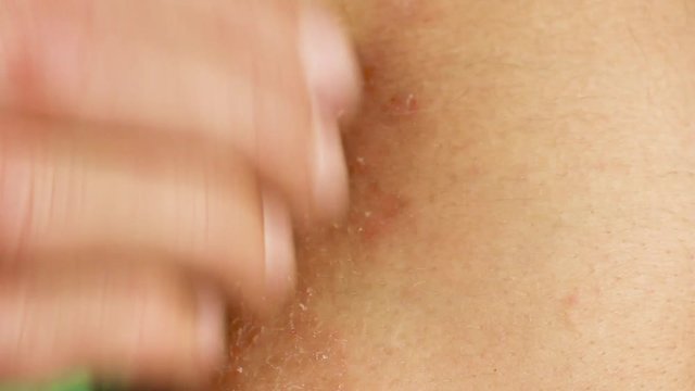 human scratches his arm with red allergic reaction, redness and peeling psoriasis on elbow, seasonal skin problem, close-up macro 
