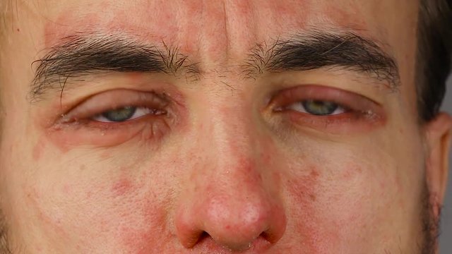 man blinks two of his eyes with red allergic reaction, redness and peeling psoriasis on face skin, seasonal dermatology problem, close-up  