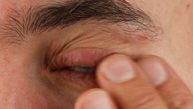 human scratches his left eye with red allergic reaction and blink, redness and peeling psoriasis on face skin, seasonal dermatology problem, close-up macro 