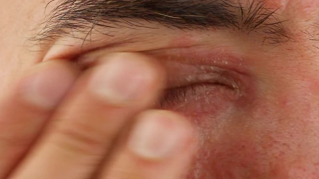 human scratches his right eye with inflammation and red allergic reaction, redness and peeling psoriasis on face skin, seasonal dermatology problem, close-up macro 