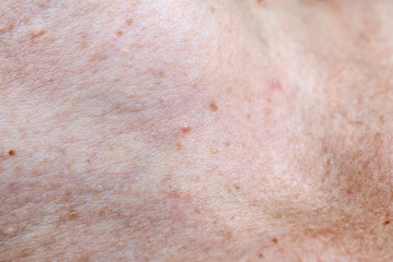 Fototapeta premium Skin pigmentation. Moles and freckles
