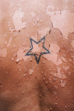 Sunburned skin peeling of