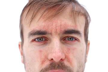 head of sick man with red allergic reaction on facial skin, redness and peeling psoriasis on nose, forehead and cheeks, seasonal skin problem, close-up, white background - obrazy, fototapety, plakaty