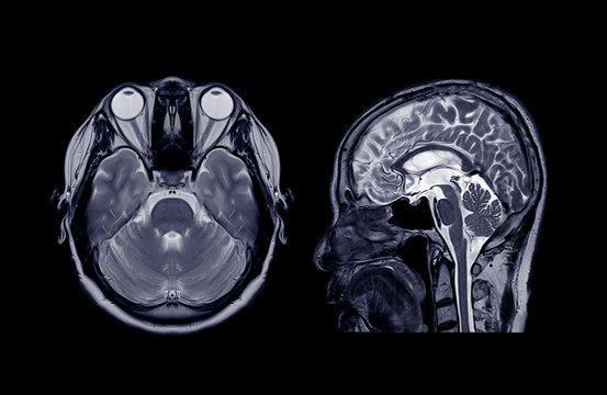 MRI of the brain axial and Coronal plane for detect Brain disease.