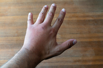 Male hand stung by bee or wasp. Hand swelling, inflammation, redness are signs of infection. Insect...