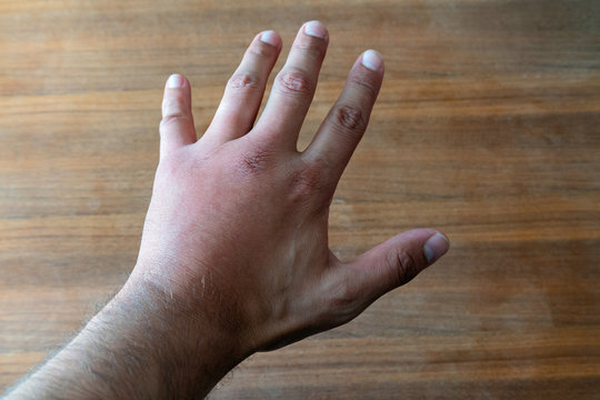 Male hand stung by bee or wasp. Hand swelling, inflammation, redness are signs of infection. Insect bite on left hand on wooden table background