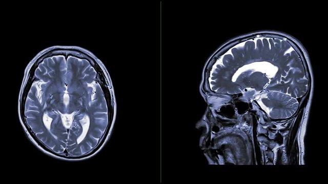 MRI of the brain axial and sagittal plane for detect Brain disease.
