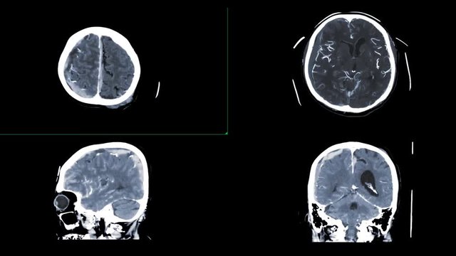 CTA brain comparison Axial,sagittal and coronal plane showing subdural hemorrhage in the brain.