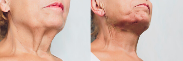 Aged woman doing mesothreads and Thread Lifting, Cosmetology. Cosmetic procedure to eliminate signs...