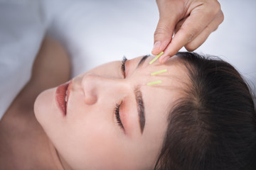 woman undergoing acupuncture treatment on head