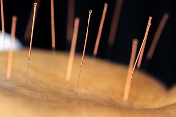 Close-up of senior female back with steel needles during procedure of acupuncture therapy