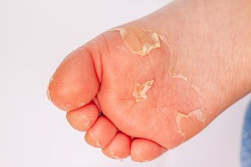 After the red rash and the strawberry tongue caused by scarlet fever the affected skin often peels - Here Skin of foot peeling