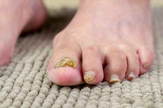 Nail fungus. Nail fungus on legs. Nail disease.Toenail fungus, onychomycosis, foot in front of white background
