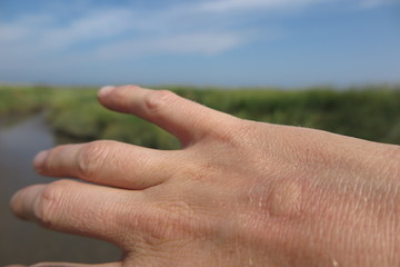 hand with mosquito bite