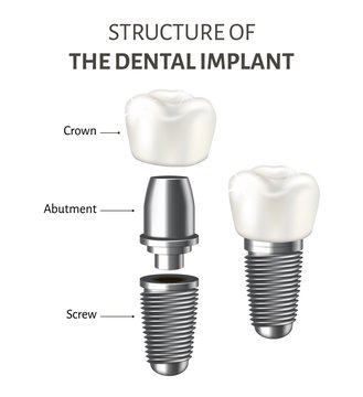 Medical poster showing a structure of the dental implant. Vector illustration isolated on the white background.