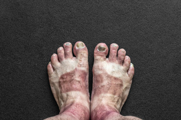 Fototapeta premium Feet with calluses and broken nails