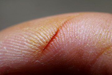 Macro Photography of injured finger