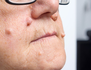 Intradermal nevus, benign tumor. A big nevus, moles, dark spots on the face of an elderly woman. Natural condition, close-up, selective focus.