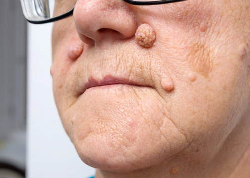 Intradermal nevus, benign tumor. A big nevus, moles, dark spots on the face of an elderly woman. Natural condition, close-up, selective focus.