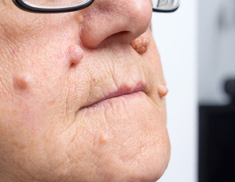 Intradermal nevus, benign tumor. A big nevus, moles, dark spots on the face of an elderly woman. Natural condition, close-up, selective focus.