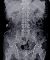 X-ray Lumbar spine impression: Multiple bone metastasis.