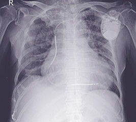Chest x-ray evere cardiomegaly. Moderate pulmonary congestion. - obrazy, fototapety, plakaty