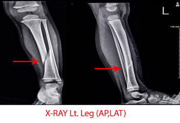 X-ray Left Leg AP Lat fracture Tibia.