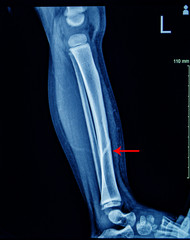 X-ray Left Leg AP Lat fracture Tibia.