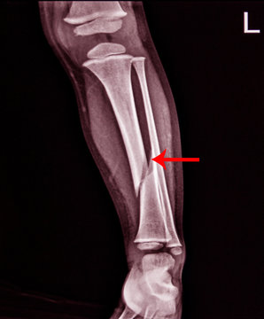X-ray Left Leg AP Lat fracture Tibia.