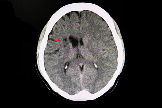 CT brain of a stroke patient